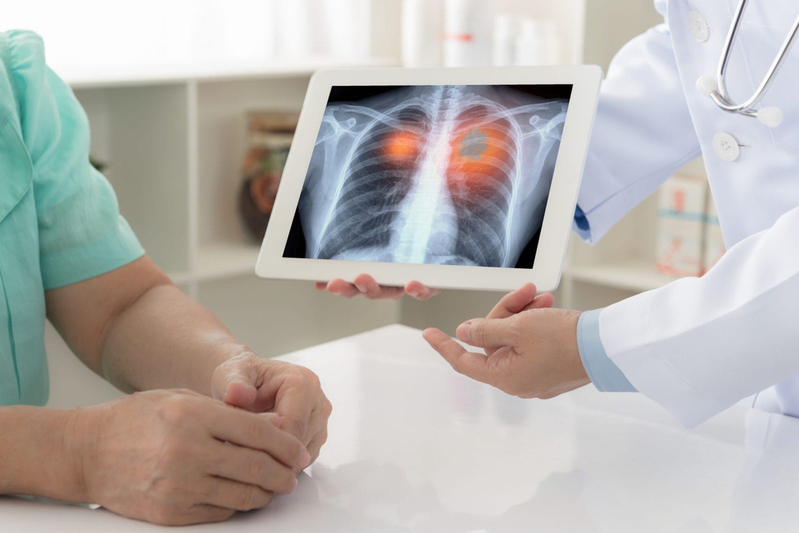 Doctor showing x-ray scan on lungs with lung cancer